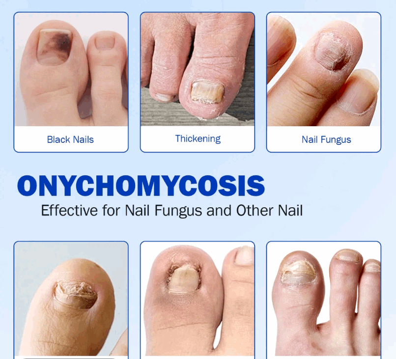 Images of damaged nails with text on onychomycosis treatment.